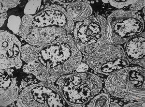 M,55y. | plasmocytoma